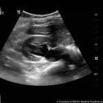אוטלרסאונד תינוק עובר הריון